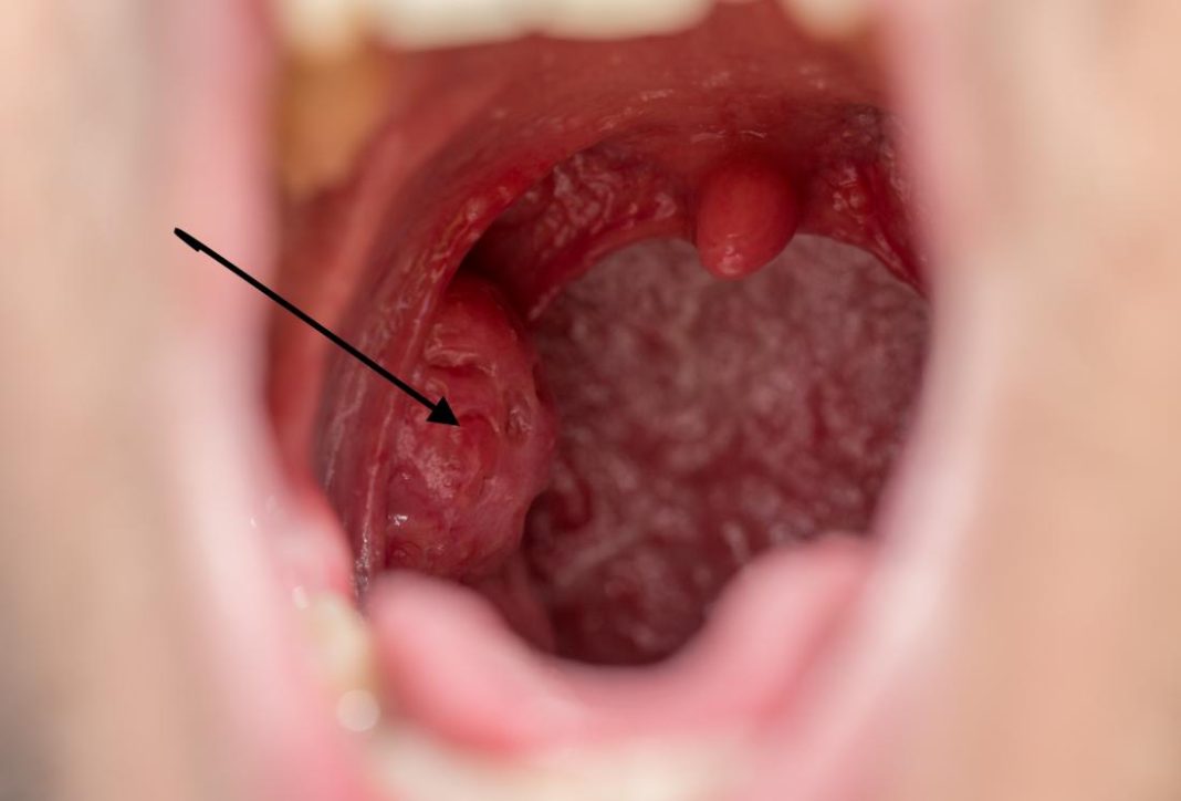 can tonsils grow back after being removed